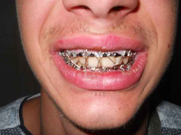 Un elev de 16 ani făcut KO de un recidivist din Apahida. Are nevoie de 50 de zile de îngrijiri medico&nbsp;legale